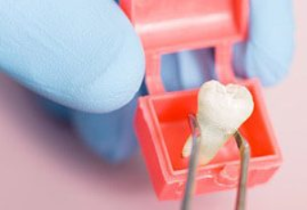 Dental Bridges