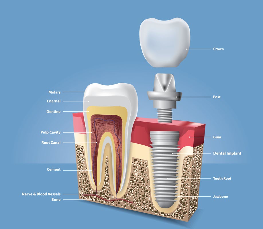 After Molar Root Canal Treatment