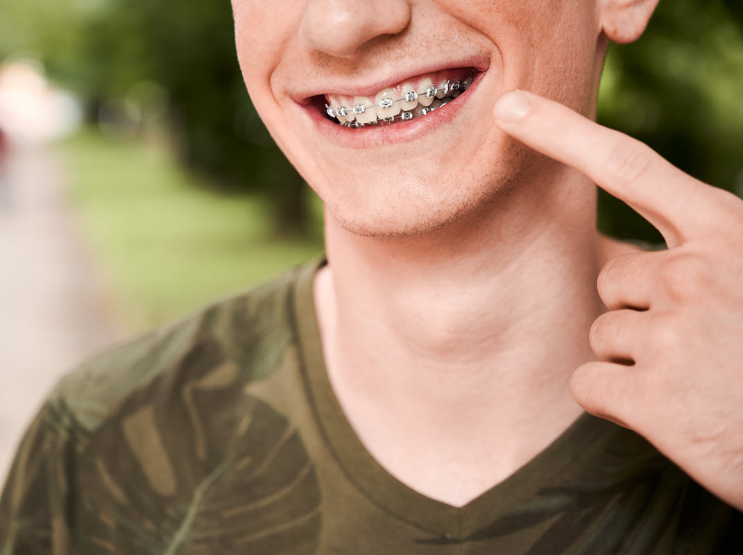Before Fixed Orthodontic Braces Treatment